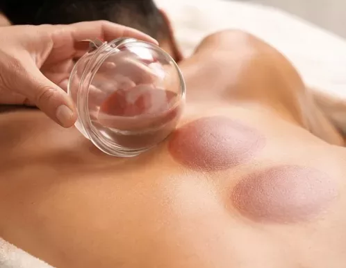 Cupping therapy treatment for back pain at CORE Ceutical Clinic Toronto