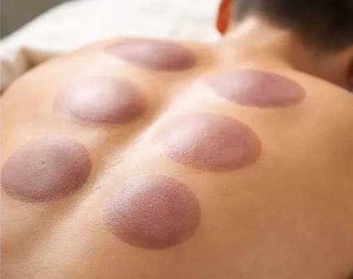 Cupping rtherapy in Newmarket eleases muscle tension and increase mobility