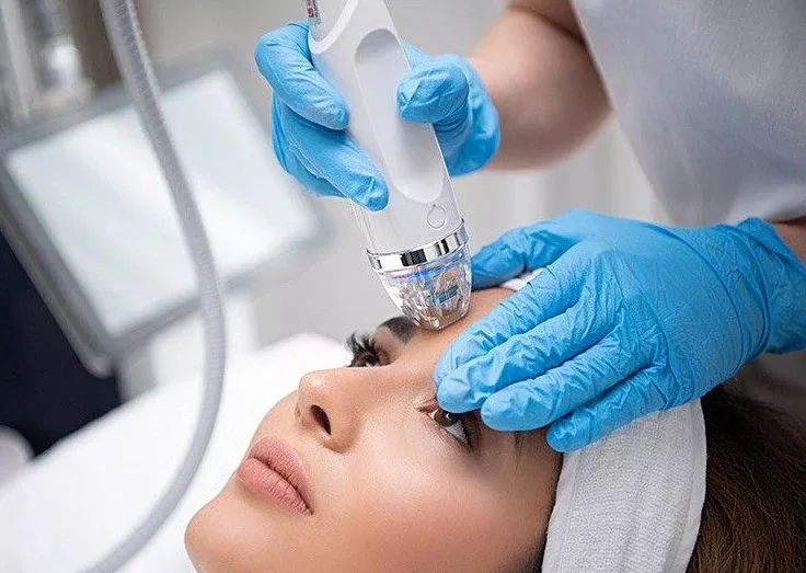 RF microneedling treatment in Newmarket for skin tightening